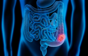 Colorectal Cancer