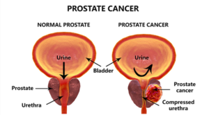 Prostate Cancer Symptoms