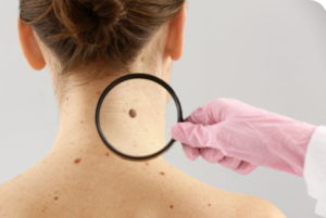 Understanding Skin Cancer
